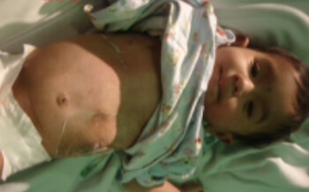 Circumcision